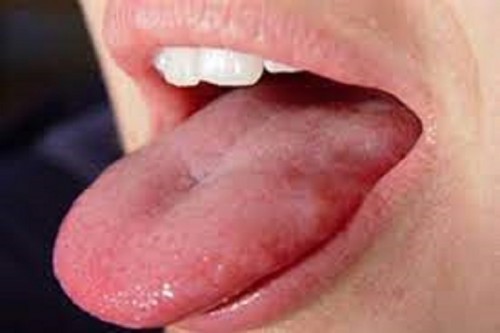 Những triệu chứng cần nghĩ ngay đến ung thư lưỡi